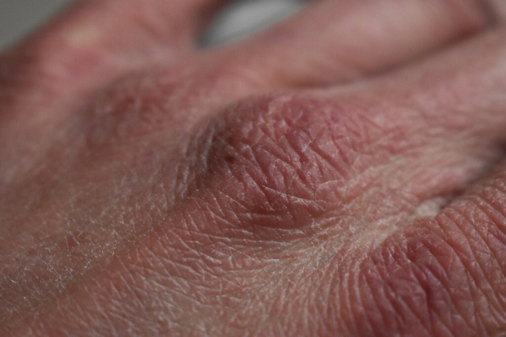 dry, skin, hands-4769578.jpg